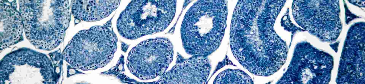 "Spermatosel Nedir? Belirtileri, Nedenleri ve Tedavisi Hakkında Bilinmesi Gerekenler"