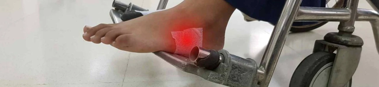 Venöz Ülser Nedir? Venöz Yetmezlik Yaraları Nasıl Olur?