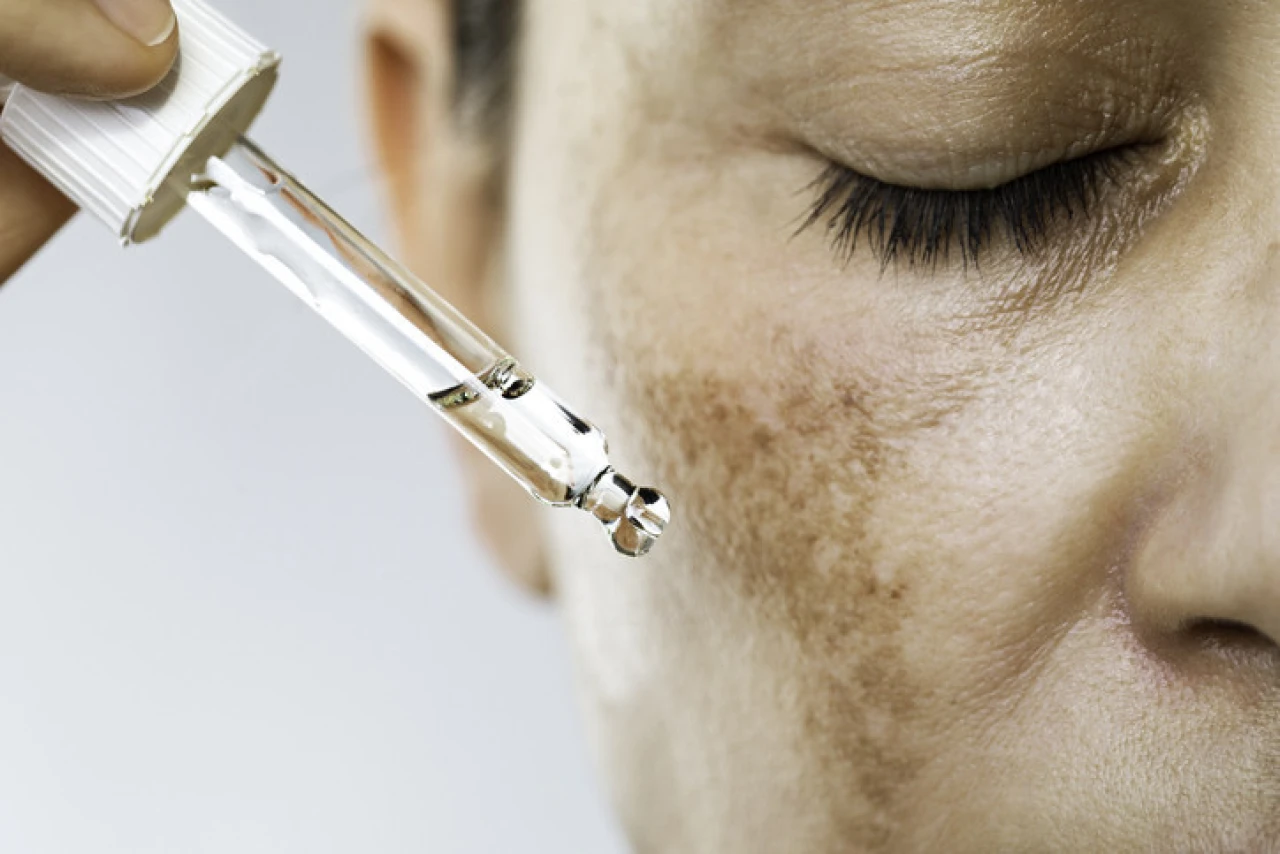 Dermatolog Dr. Zahide Eriş Zorlu, leke tedavisinde etkili yöntemleri açıkladı: Güneş koruyucular önemli!