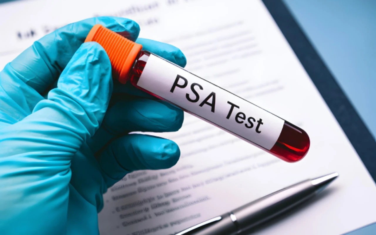 PSA Nedir? Neden Yapılır? PSA Testi Değerleri Kaç Olmalı?