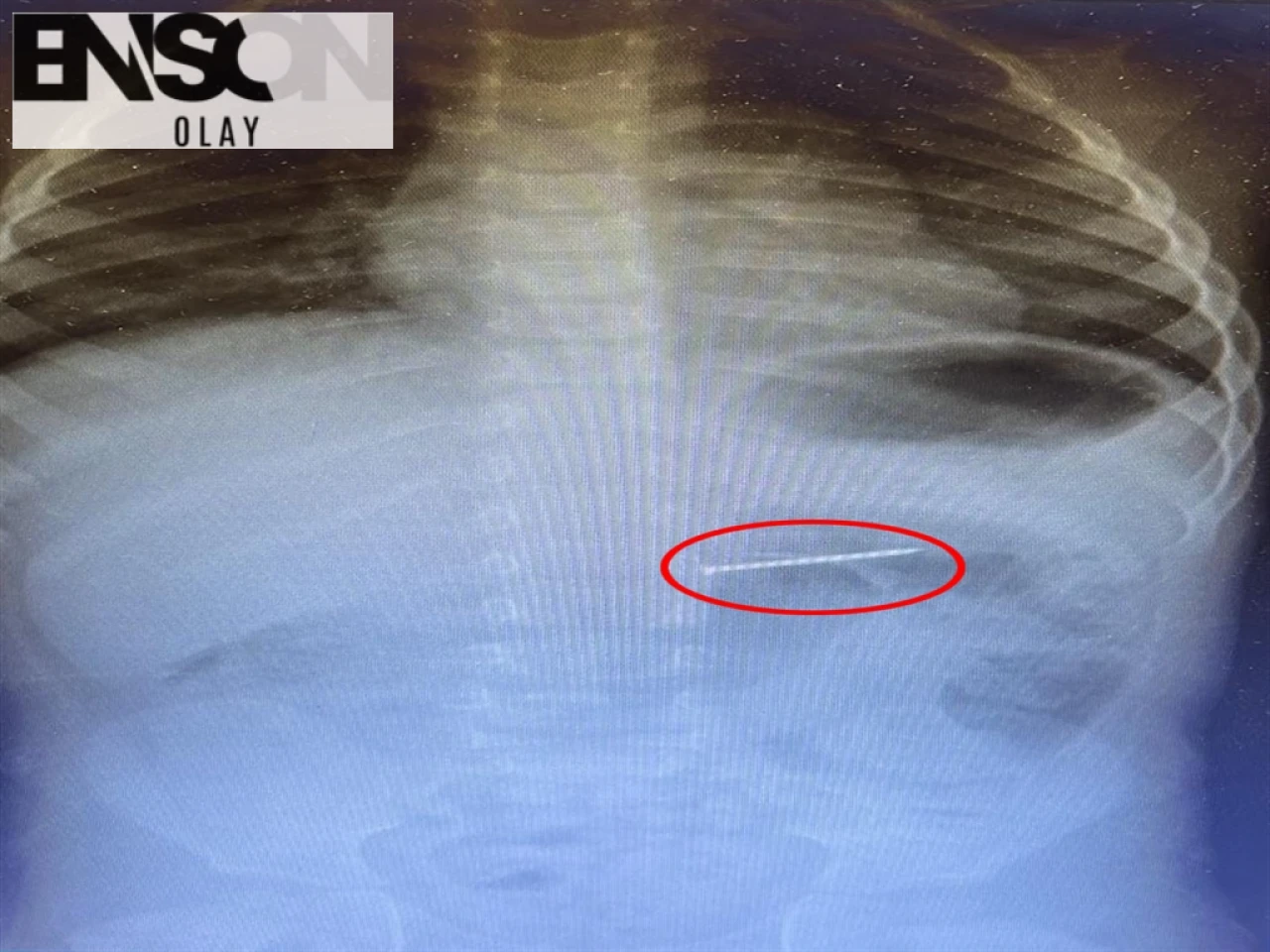 Bucak'ta 2 yaşındaki çocuğun midesinden çıkarılan 4 cm uzunluğundaki çivi endoskopik yöntemle çıkarıldı.