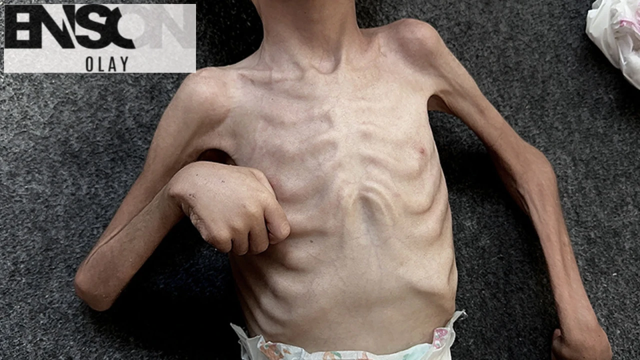 Gazze'de Açlıktan Ölenlerin Sayısı Artıyor: Son 24 Saatte 8 Çocuk Hayatını Kaybetti