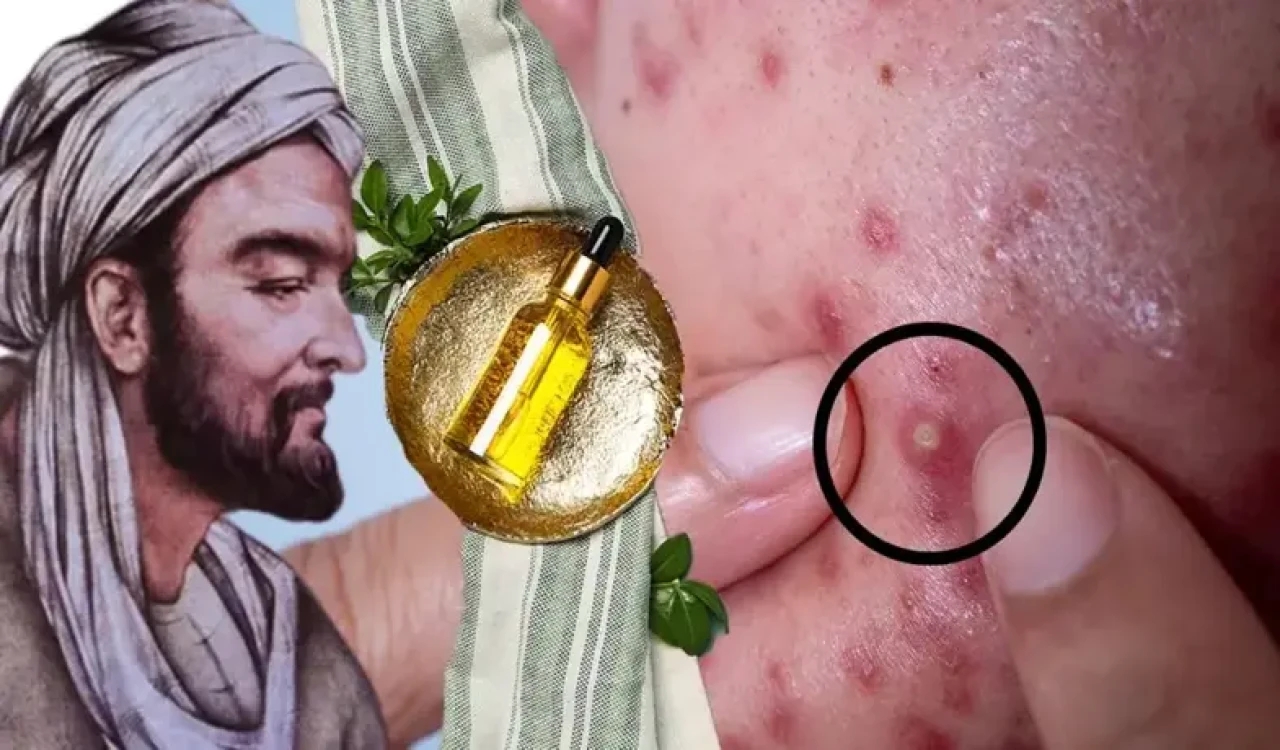 İbn-i Sina'nın sivilce reçetesi! Kremleri gölgede bırakan yağ