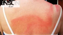 Güneş yanıklarından kurtulmak için doğal yöntemler nelerdir?
