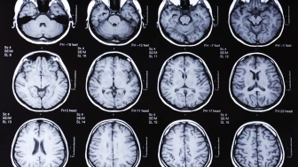 Prion hastalığı nedir, nasıl bulaşır? Türkiye'de var mı?