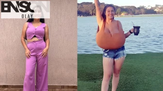 Sadece 300 kişide görülen hastalık: Göğüsleri aylar içinde 12 kiloya ulaştı