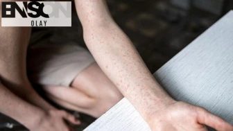 Kızamık alarmı: Can kayıpları var, çok sayıda kişi hastaneye kaldırıldı