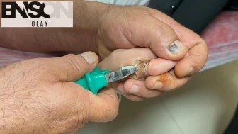 Adıyaman'da çocuğun parmağına sıkışan metal cisim, kesilerek çıkarıldı