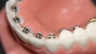 Diş teli fiyatları nedir ve hangi faktörler etkiler?