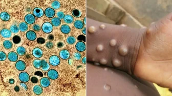 M çiçeği virüsü nedir? Kenya'da M çiçeğ virüsü salgını