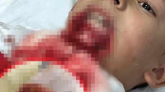 Çanakkale'de demir saplanan çenesi parçalanan öğrencinin davasında 4’üncü duruşma görüldü