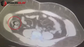 Kars'ta yakalanan kuryenin midesinden 76 kapsül uyuşturucu çıktı