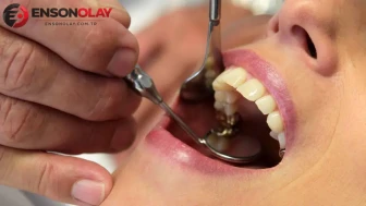 Dişlerimizde Yer Alan Görünmeyen Tehlikeler İçin Dikkat! Ağız Sağlığı Neden Önemlidir?