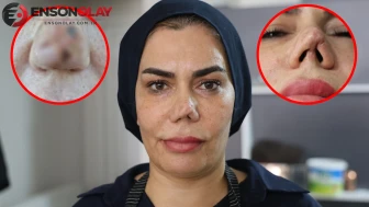 "Yüzümü insanlardan saklıyorum" diyerek dava açtı: Kırılan burnunu düzeltmek isterken hayatı kabusa döndü