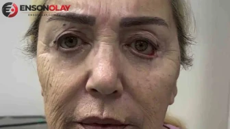 Ünlü şarkıcı Nursel Sayan, estetik operasyon sonrası değişimini takipçileriyle paylaştı!