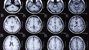 Prion hastalığı nedir, nasıl bulaşır? Türkiye'de var mı?