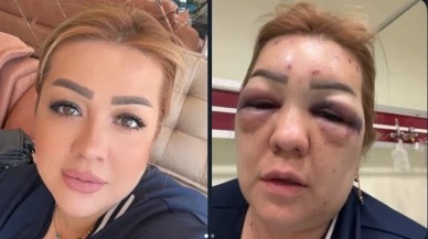 Kahramanmaraş’ta Botoks Sonrası Hastanelik Oldu