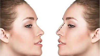 Septoplasti: Burun Septumu Eğriliği Ameliyatı