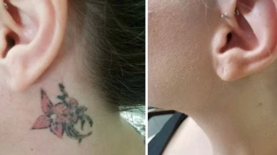 Ramazan'da dövme sildirmeyi ücretsiz yaptılar