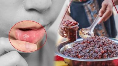 Ağız yaraları ve aftalar için eczaneye gerek kalmıyor! 1 yudumu ağzın içini dip köşe yıkıyor