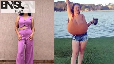 Sadece 300 kişide görülen hastalık: Göğüsleri aylar içinde 12 kiloya ulaştı