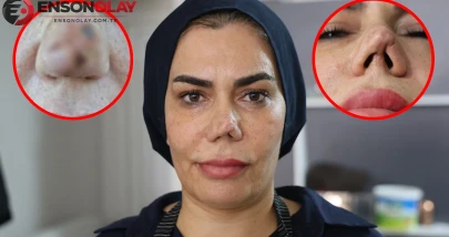 "Yüzümü insanlardan saklıyorum" diyerek dava açtı: Kırılan burnunu düzeltmek isterken hayatı kabusa döndü