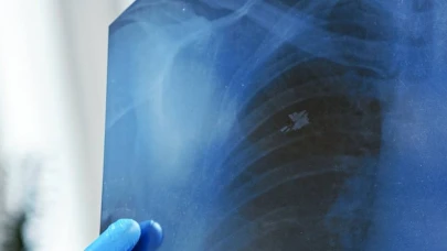 Ampiyem Nedir? Ampiyem Belirtileri, Nedenleri ve Tedavisi