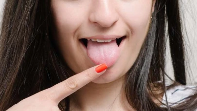 Dil İltihabı (Glossit) Hakkında Bilmeniz Gerekenler ve Belirtileri Nelerdir?