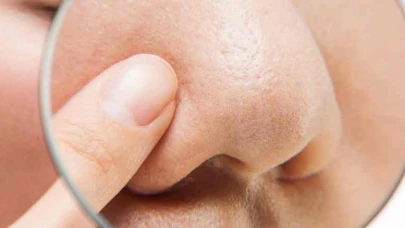 Sebum Nedir? Sebum Ne İşe Yarar?