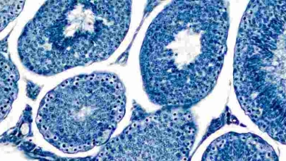 , erkeklerde testislerin etrafında oluşan sıvı dolu kistlerdir. Bu durum genellikle ağrısız olup, genellikle rahatsızlık vermez. Spermatoselin belirtileri arasında testislerde ağrısız şişlik, testislerde ağırlık hissi ve testislerde sıvı dolu kesecikler yer alabilir. Spermatosel genellikle herhangi bir tedavi gerektirmez ancak kist büyürse veya ağrı yapmaya başlarsa cerrahi müdahale gerekebilir.