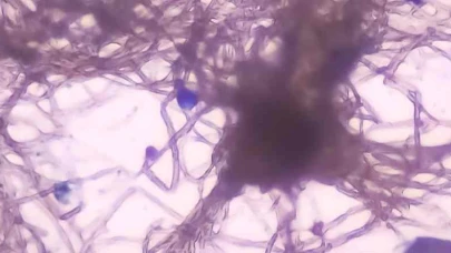 Tinea Versikolor Nedir? Tinea Versikolor Belirtileri Ve Tedavisi
