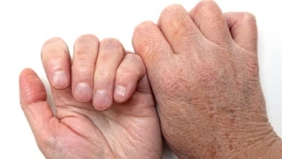 Tırnaklarda görülen beyaz lekelerin sebepleri ve tedavi yöntemleri hakkında bilgiler verilecektir