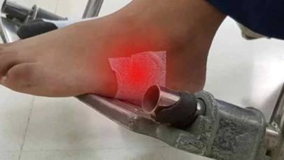 Venöz Ülser Nedir? Venöz Yetmezlik Yaraları Nasıl Olur?