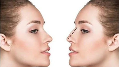 Septoplasti: Burun Septumu Eğriliği Ameliyatı
