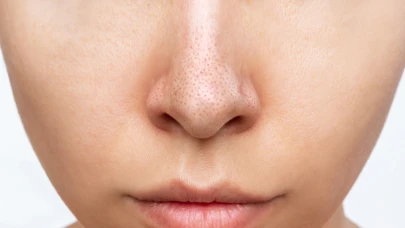 Cildinde siyah noktalardan şikayetçi olanlar için mucizevi çözüm bulundu! Bebek gibi pürüzsüz bir cilde kavuşmanın sırrı ortaya çıktı!