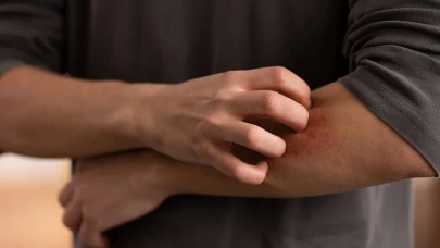 Isırılmadan Önce Okuyun! Baharın Sessiz Tehlikesi Her An Sizi Bulabilir