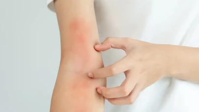 Böcek Isırığına İlk Yardım Nasıl Yapılmalıdır? - Kızarıklık, Şişlik ve Kaşıntı Belirtilerine Karşı Öneriler