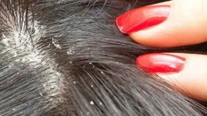 Okullarda Bit Sorunuyla Baş Etmenin Yolları Neler?