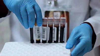 Kan Grubunuzun Sağlığınız Üzerindeki Etkisi Ortaya Çıktı: 3 Kan Grubunda Kanser Riski Yüzde 55 Artıyor!