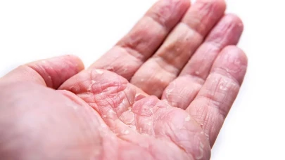 Eldeki su kabarcıkları nasıl geçer? İşte çözüm