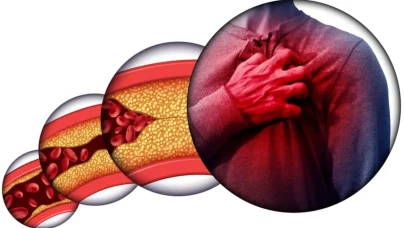 Karaciğer yağlanması MASLD'nin Türkiye'deki riskli yükselişi!