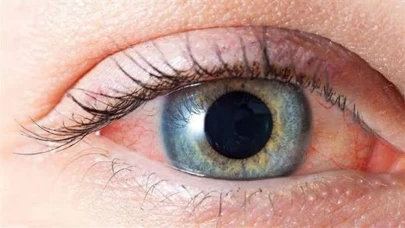 Bahar alerjisi, göz sağlığını olumsuz etkiliyor: Göz doktorları uyarıyor