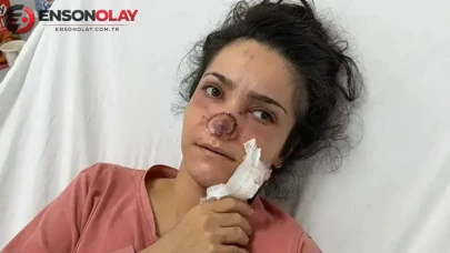 Manisa’da eşinin ısırarak kopardığı burnu ameliyatla dikildi : 'Sonuna kadar şikayetçiyim'