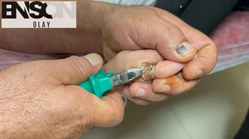 Adıyaman'da çocuğun parmağına sıkışan metal cisim, kesilerek çıkarıldı