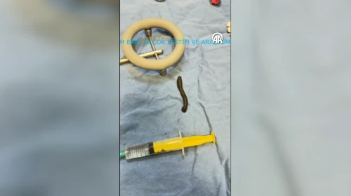 Çorum'da bir hastanın boğazından canlı sülük çıktı