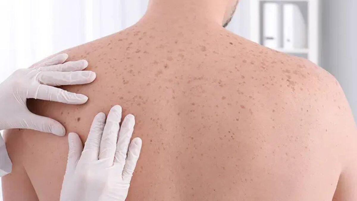Onkoloji dünyasında tarihi başarı: Moderna’nın kişiselleştirilmiş mRNA kanser aşısı nüks riskini yüzde 42 düşürdü